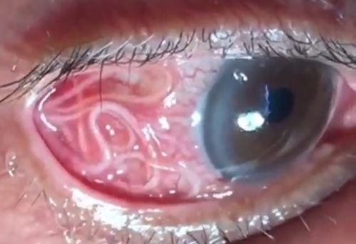 Worms infection in the eye Photo 0001