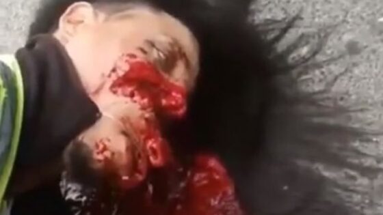 Man victim of traffic accident has his face completely disfigured Photo 0001 Video Thumb