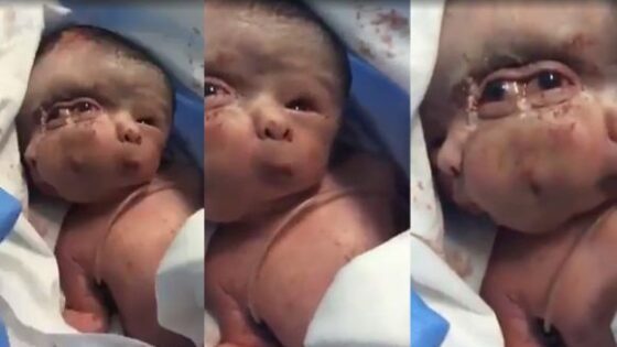 Woman gives birth to deformed siamese twins baby joined at head with three eyes Photo 0001 Video Thumb