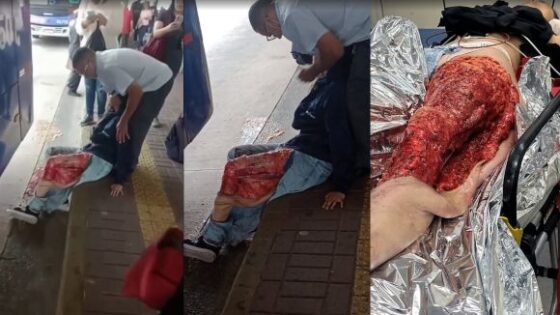 Woman leg crushed by bus Photo 0001 Video Thumb