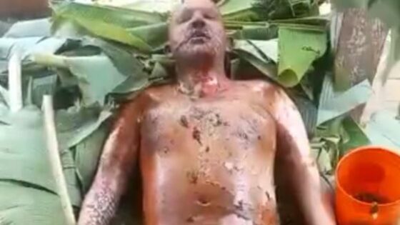 Man burned but still alive Photo 0001 Video Thumb