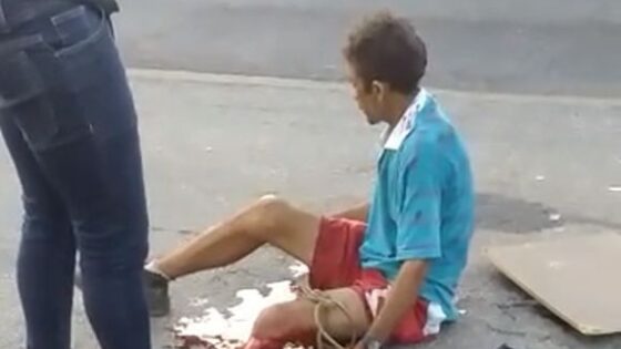 Man had his leg torn off in accident Photo 0001 Video Thumb