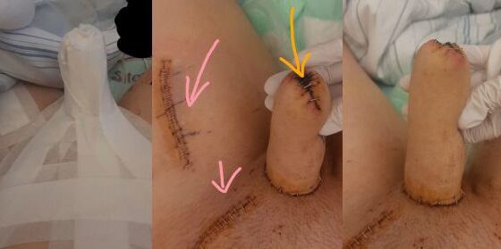 Result of surgery to transform female genital organ into male genital organ Photo 0001 Video Thumb
