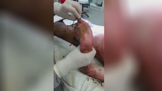 Doctors removing skin from a patient who has suffered third degree burns Photo 0001 Video Thumb