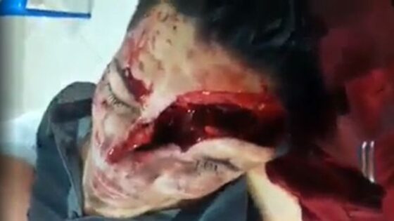 Man has his face mutilated after attack with machete Photo 0001 Video Thumb
