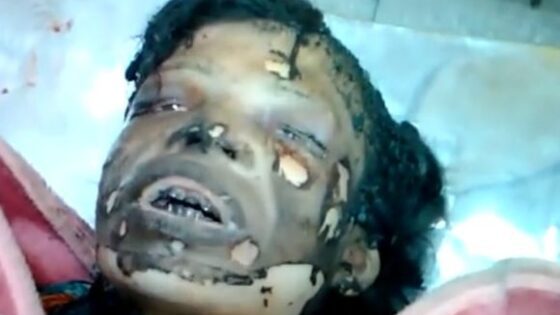 Woman attacked with acid and fire is unrecognizable after attempted murder in india Photo 0001 Video Thumb