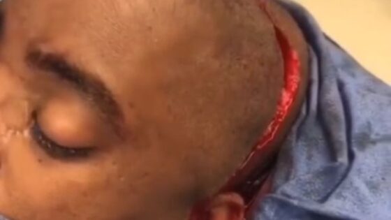 Man having his head cut open in autopsy in some country of the world Photo 0001 Video Thumb