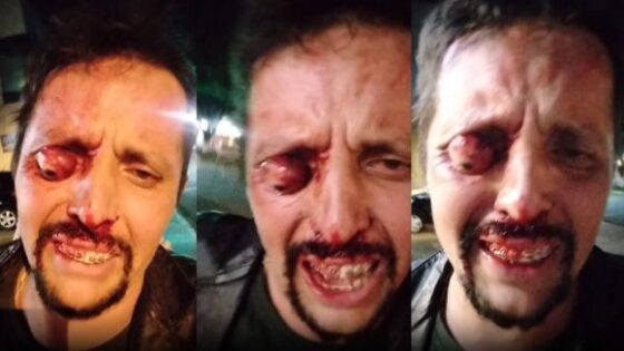 Man under the influence of alcohol gets into trouble in brazil and loses his eye Photo 0001 Video Thumb
