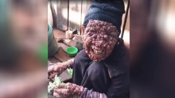Man with rare disease leaves skin full of warts Photo 0001 Video Thumb