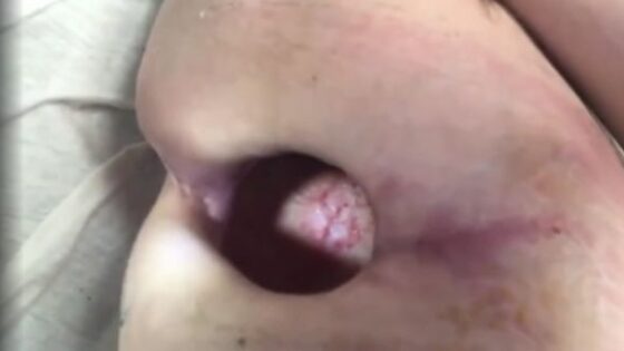 Man still alive even hole is in his back Photo 0001 Video Thumb