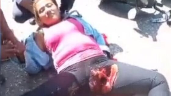 Womans genital ripped wide open after brutal motorcycle accident Photo 0001 Video Thumb