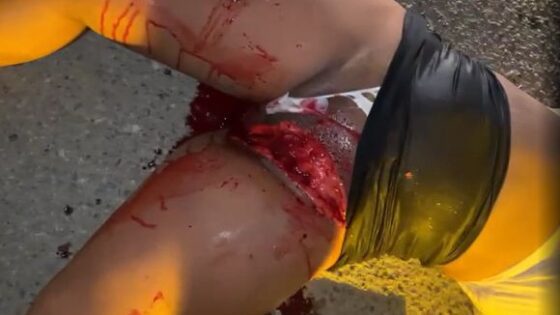 Female genitalia torn in motorcycle accident Photo 0001 Video Thumb