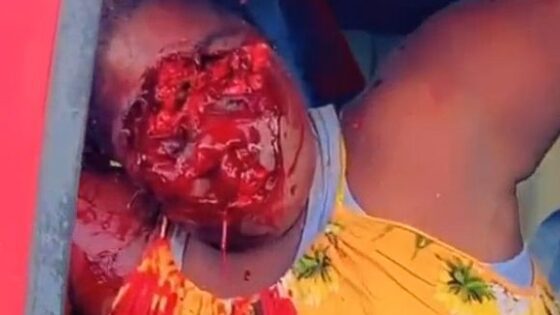 Woman leaves face completely destroyed in traffic accident in jamaica Photo 0001 Video Thumb
