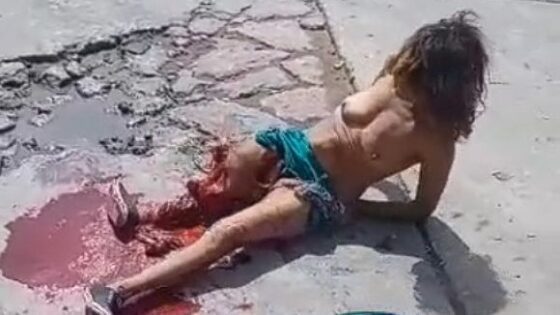Elderly woman with her breasts exposed and her right leg shattered due to a traffic accident Photo 0001 Video Thumb