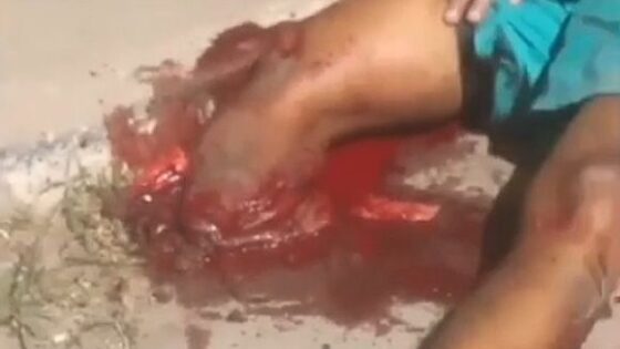 Cyclist has his leg destroyed in brazil after being involved in a traffic accident on a poorly maintained road Photo 0001 Video Thumb