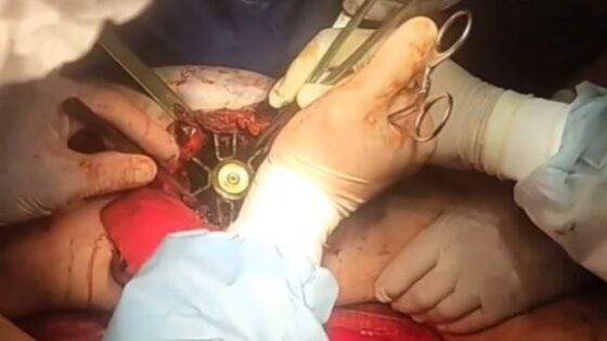 Doctor removing huge piece of gear stuck in the leg of man who is fighting for his life Photo 0001 Video Thumb