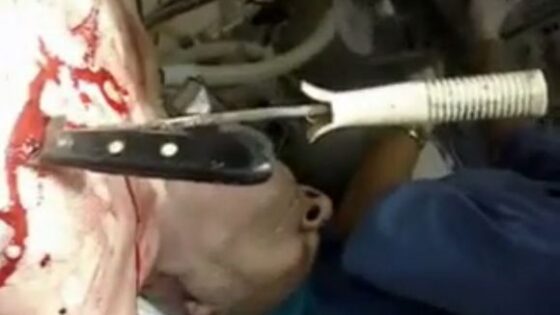 Doctors try to save the life of a man with a knife stuck in his heart Photo 0001 Video Thumb