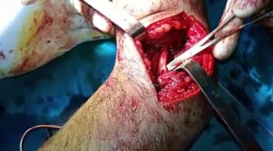 Incredible surgery to repair a human arm Photo 0001 Video Thumb