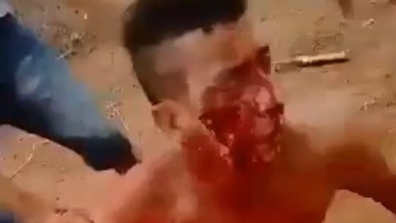 Man is shot in the face in brazil but survives to tell his story Photo 0001 Video Thumb