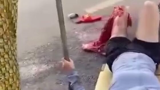 Traffic accident leaves woman with mutilated leg in some asian country Photo 0001 Video Thumb