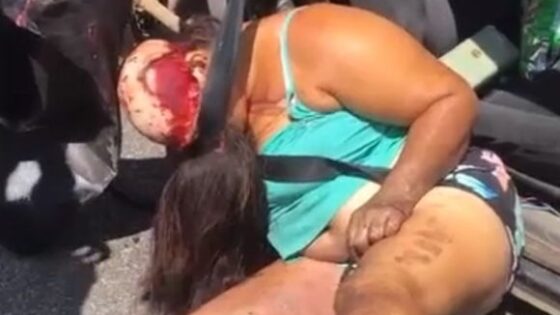 Woman suffers terrible scalping after being victim of traffic accident Photo 0001 Video Thumb