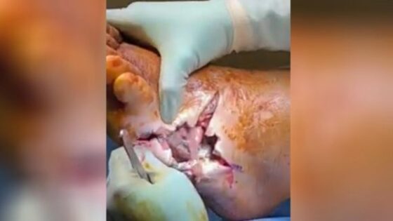 Surgery on a foot that is in an advanced state of putrefaction the surgery performed is an attempt to save the foot Photo 0001 Video Thumb