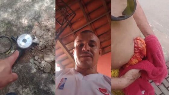 Mans bowels exposed after angle grinder accident Photo 0001 Video Thumb
