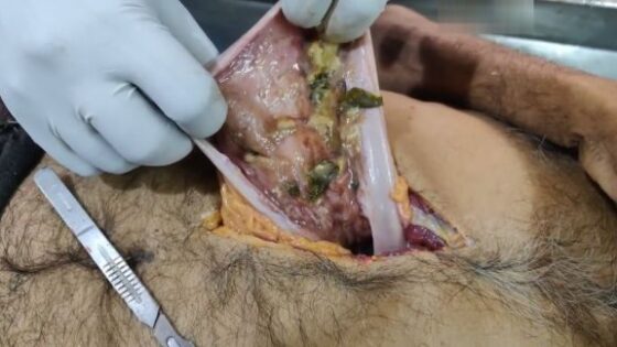 Autopsy of dead man electrocuted in india Photo 0001 Video Thumb