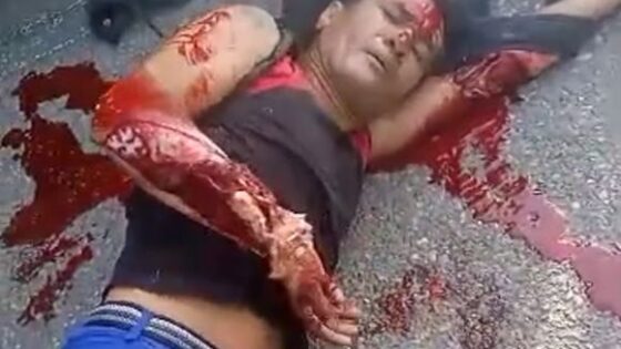 Man hit by truck has completely mutilated arm Photo 0001 Video Thumb