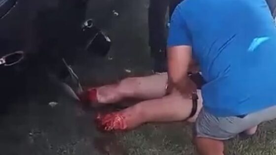 Woman suffers car accident and loses both feet crushed and cut off by the vehicle Photo 0001 Video Thumb