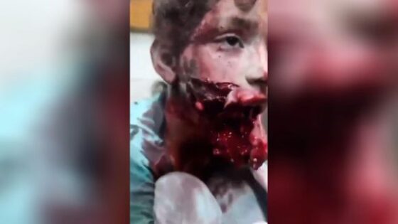 Child has her jaw blown off due to israeli bombing of lebanon in the israel vs lebanon war Photo 0001 Video Thumb