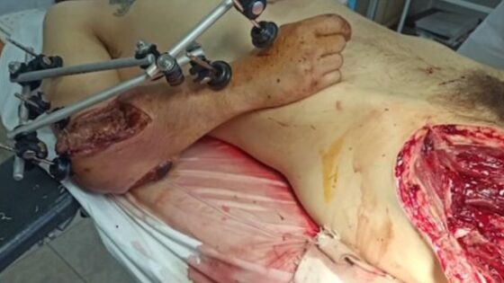 Compilation of brutal war injuries Photo 0001 Video Thumb