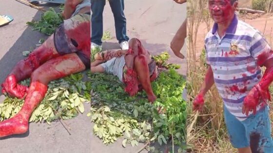 Traffic accident in brazil leaves pedestrians legs completely destroyed its a shame he has to go through this Photo 0001 Video Thumb