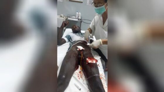 Man loses his genitals and now needs to urinate through a straw Photo 0001 Video Thumb