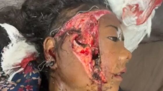 The girl lost her face in a car accident but managed to survive Photo 0001 Video Thumb