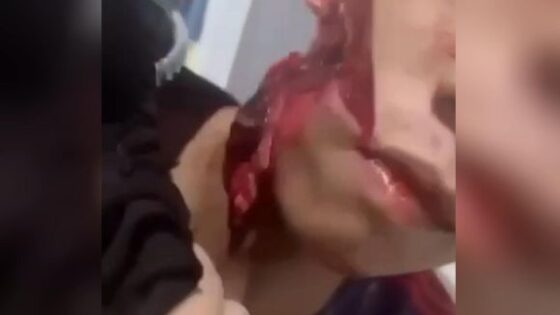 Boy has brutal mutilation on his face Photo 0001 Video Thumb