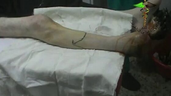 Rotten foot removal due to diabetes Photo 0001 Video Thumb