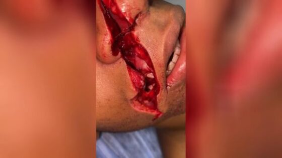 Wait allow me to put this bloody germ filled fabric on your sliced face… oh let me also take a peek inside and open your face while your awake11 Photo 0001 Video Thumb
