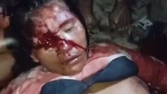 Woman stabbed in the eye by her boyfriend in peru now mourns her terrible suffering Photo 0001 Video Thumb