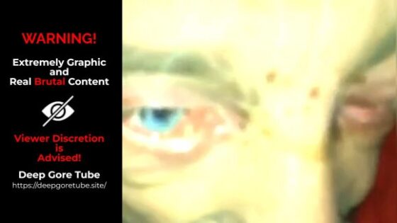 Hes completely fucked up with his eye maggots Photo 0001 Video Thumb